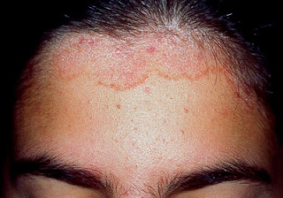 Que curar la psoriasis por la homeopatía
